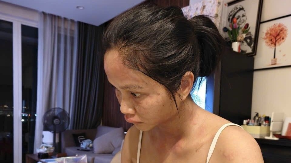 H'Hen Niê nổi mề đay sau sinh: Căn bệnh cứ 10 mẹ bỉm thì 1 người mắc phải