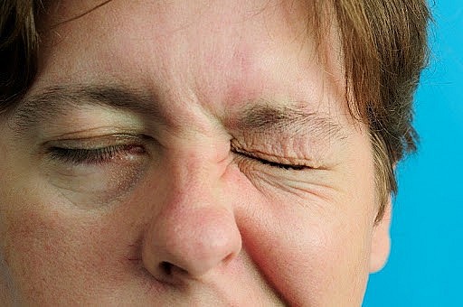 Liệt dây thần kinh số 7 ngoại biên là tình trạng dây thần kinh này bị tổn thương ở phần ngoại biên, gây ra tình trạng liệt gần như toàn bộ các cơ ở một nửa mặt. Liệt dây thần kinh số 7 ngoại biên là tình trạng dây thần kinh này bị tổn thương ở phần ngoại biên, gây ra tình trạng liệt gần như toàn bộ các cơ ở một nửa mặt.