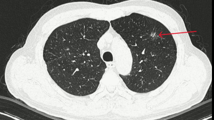 Bệnh nhân được phát hiện ung thư phổi giai đoạn rất sớm nhờ hệ thống phân tích hình ảnh bằng trí tuệ nhân tạo (AI)
