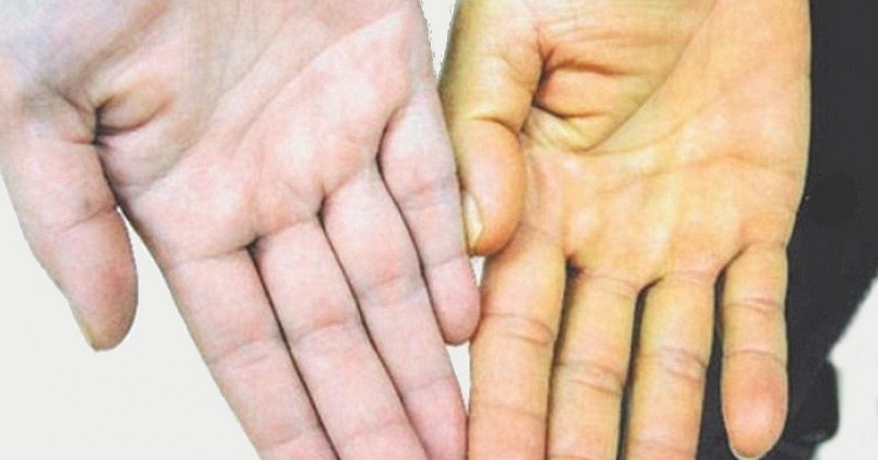 Đáng lưu ý, có tới 95–97% trẻ bị lây nhiễm từ mẹ sẽ tiến triển thành viêm gan B mạn tính. Đây là nguồn dự trữ mầm bệnh lâu dài, làm gia tăng đáng kể nguy cơ xơ gan và ung thư gan trong tương lai cho thế hệ sau.