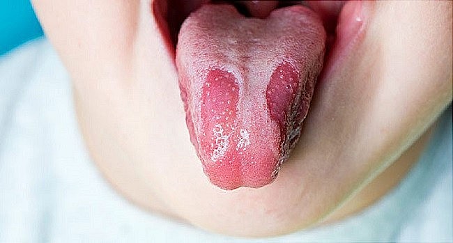 Lưỡi có các vết loét và lâu lành hoặc có  khối u màu đỏ, trắng rất có thể là dấu hiệu của bệnh ung thư...
