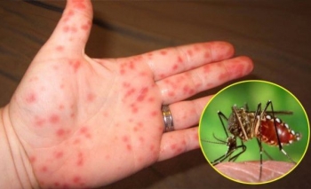 Bộ Y tế khuyến cáo về phòng chống sốt xuất huyết